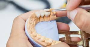 Dental Implants Santa Fe NM: What You Should Know Before Treatment